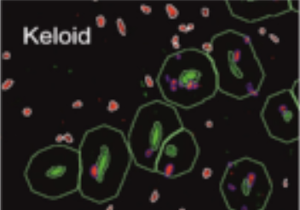 Keloid Immune Microenvironment