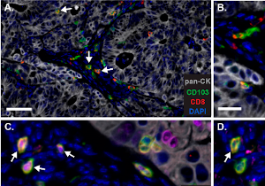 TCells In CRLM