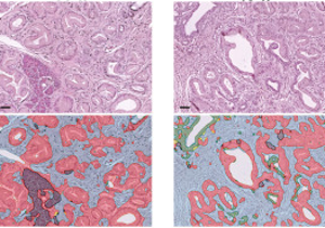 COL8A1 Pancreatic Tumor