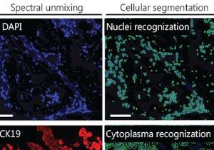 AI-tumor-profiles