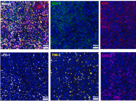 USP2a lung cancer