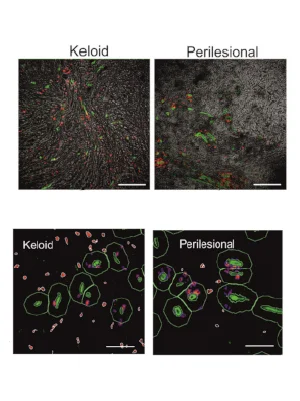 Multi-Antigen Imaging Reveals Key Drivers of Keloid Formation