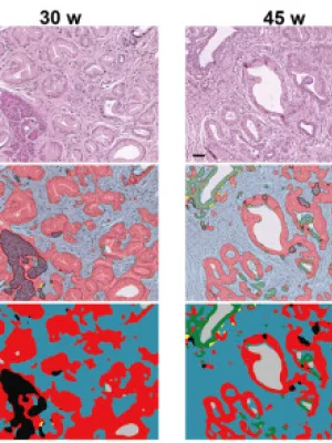COL8A1 Promotes Tumor in Pancreatic Ductal Adenocarcinoma