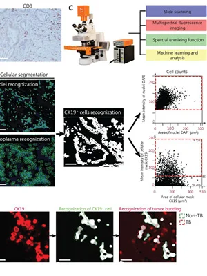 AI-Assisted Analysis of ‘Anti-/Pro-Tumor’ Profiles for Pancreatic Adenocarcinoma