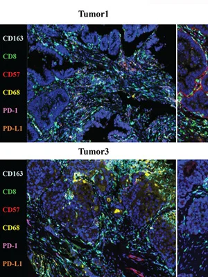 Case Report: Tumor Microenvironment Characterization of Rectal Cancer