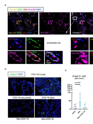 Temporal changes in T cell subsets and expansion of cytotoxic CD4+ T cells in the lungs in severe COVID-19