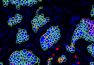 Tumor Cells from Blood Vessels