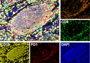 Mature TLS Can Predict the Progression of Lung Squamous Cell Carcinoma